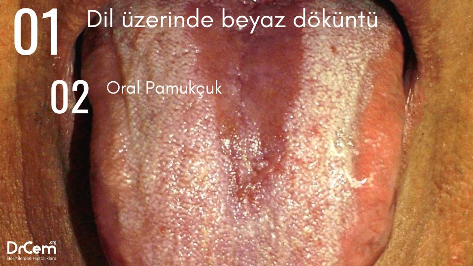 Oral Pamukçuk görseli - DrCem hastalık rehberi